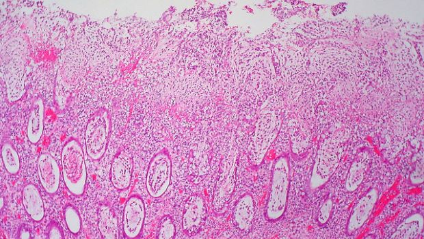 La colite ulcerosa o spastica: ecco come si cura