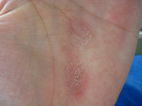 L&#8217;alukina è efficace contro la dermatite seborroica? Opinioni e pareri a confronto