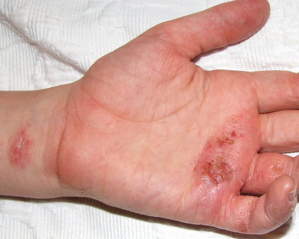 Cos’è la dermatite atopica e quali sono i rimedi naturali