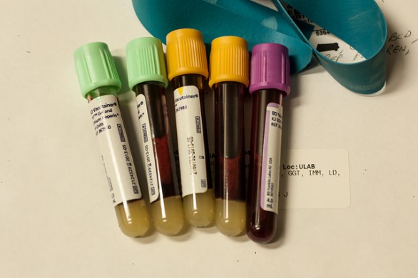 I sintomi dell&#8217;anemia mediterranea, la diagnosi e i test da fare