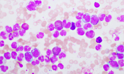 leucemia mieloide