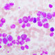 leucemia mieloide