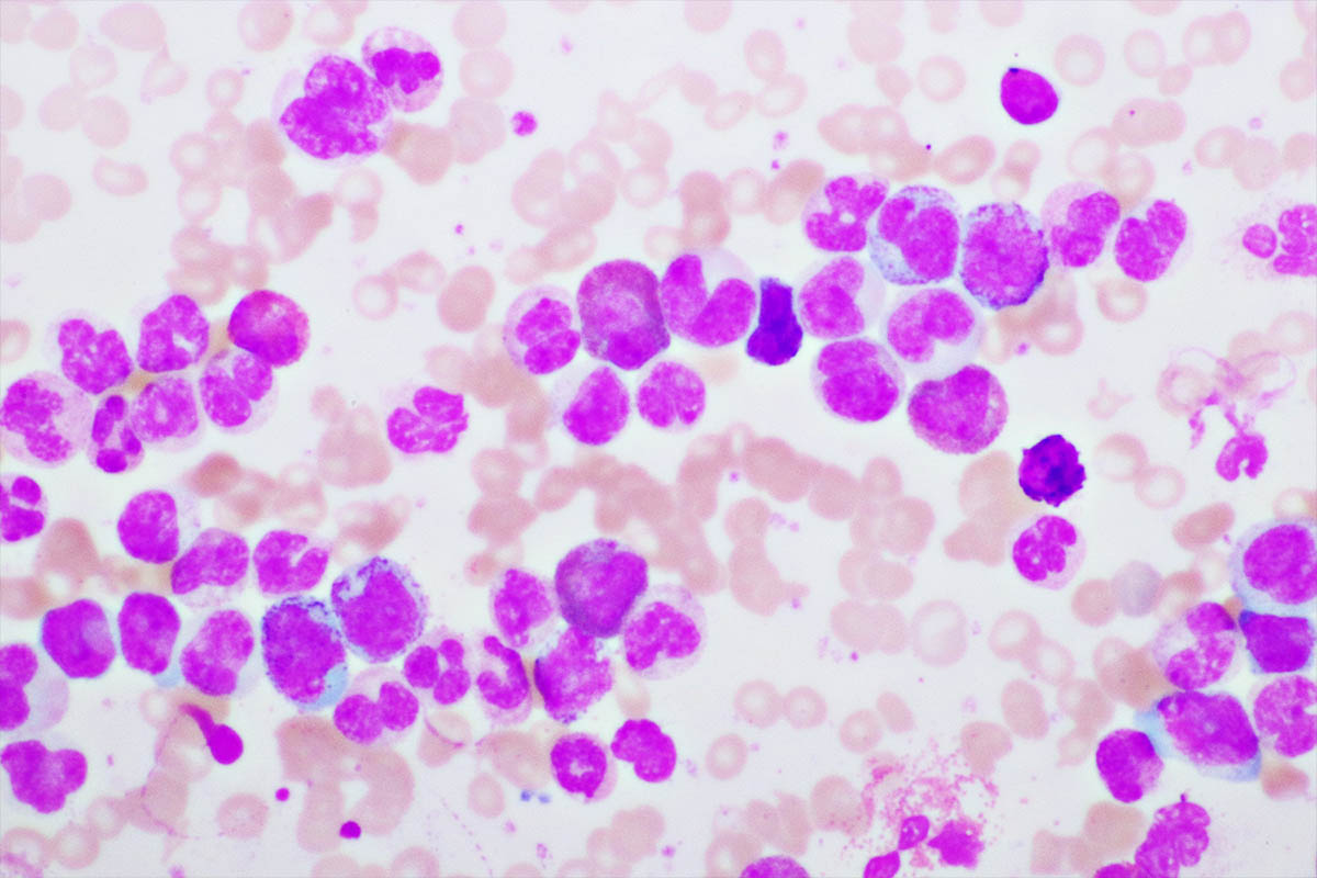 leucemia mieloide