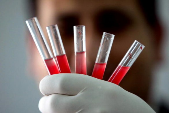 Globuli rossi bassi: i sintomi, le cause e le cure più efficaci