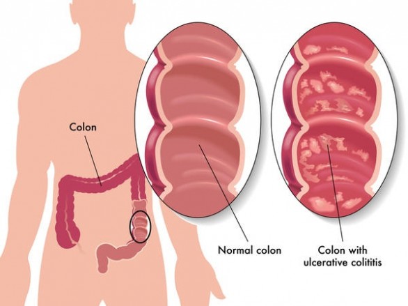 Morbo di Chron e colite ulcerosa, ecco le differenze