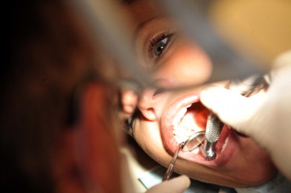 Le cause della placca dentale e come eliminarla