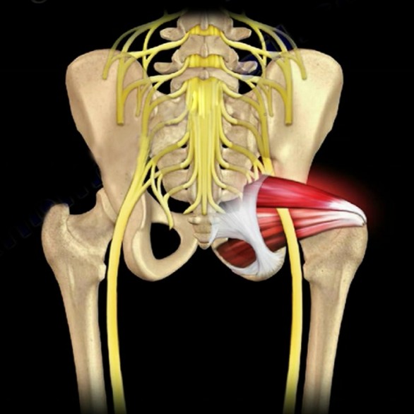 Cos&#8217;è la sciatalgia cronica? I sintomi, le cause e la terapia