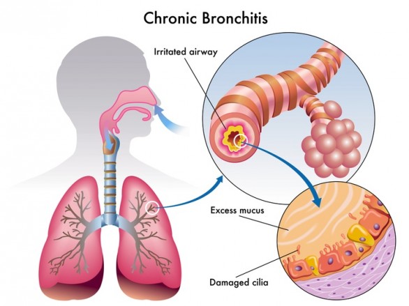 Bronchite cronica: ecco le cure più efficaci