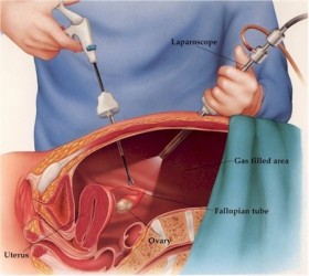 Laparoscopia ginecologica, quando fare questo test e a cosa serve