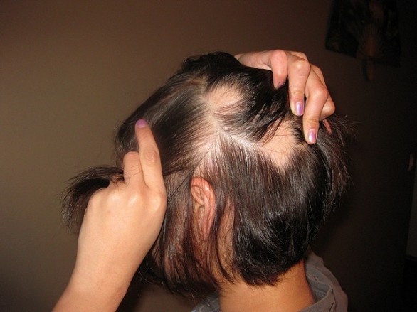 Ecco le cure naturali per l&#8217;alopecia femminile