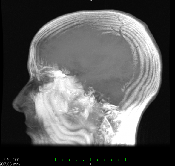 Edema cerebrale: sintomi, cause e cure