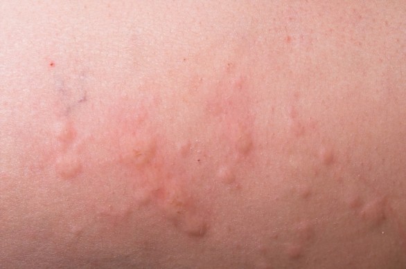 La cura per l&#8217;orticaria colinergica e quali sono i sintomi