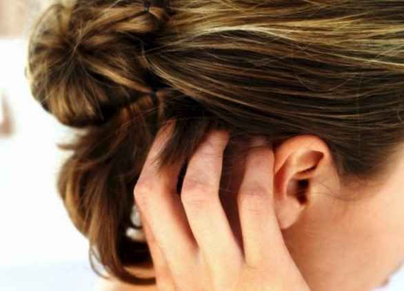 Dermatite seborroica del cuoio capelluto nelle donne: le cause e le cure più efficaci