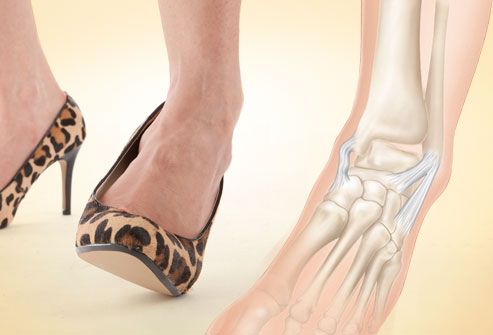 La distorsione della caviglia: sintomi, cause e cure