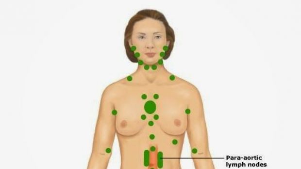 Linfonodi gonfi del collo, ascellari e inguinali: sintomi, cause e cure
