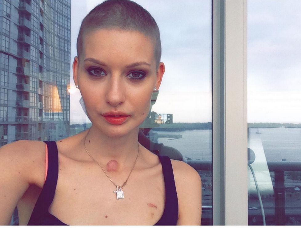 Modella di 25 anni sfida il cancro mostrandosi su Instagram segnata dalla malattia