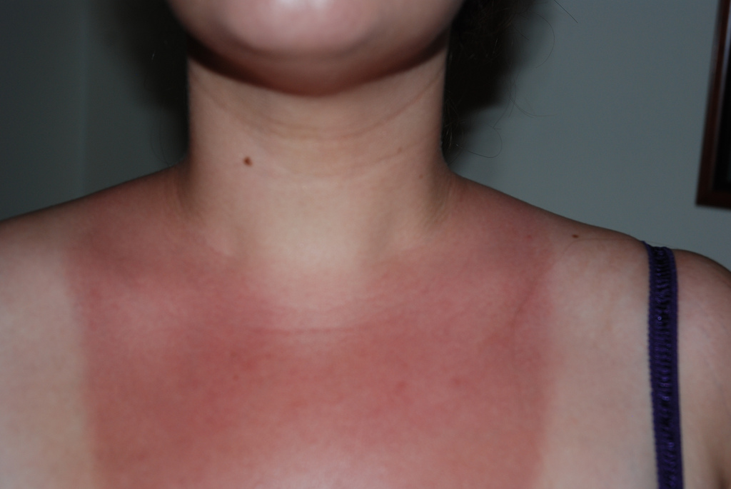 Lenire pelle arrossata sole rimedi naturali