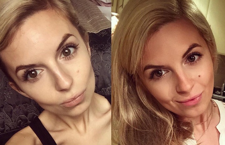Ragazza sconfigge l’anoressia e racconta la sua storia su Instagram