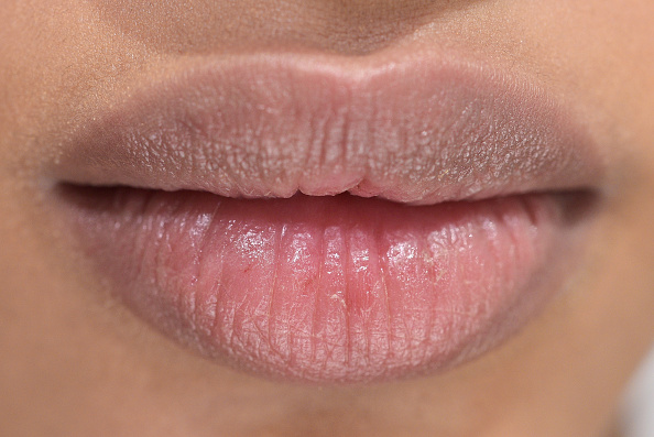 Cinderella Lips filler