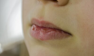 Labbra screpolate
