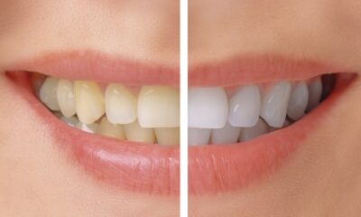 Evitare cibi che macchiano i denti