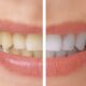 Evitare cibi che macchiano i denti