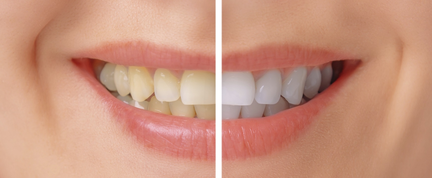 Evitare cibi che macchiano i denti