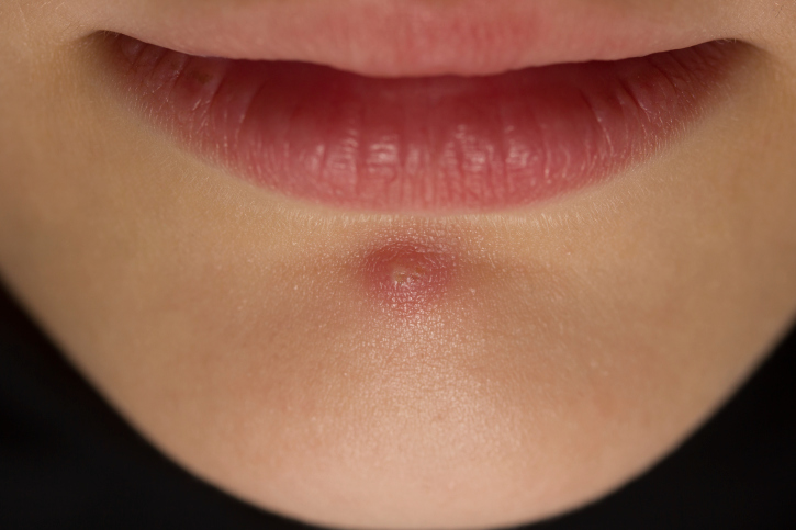 5 cose che ogni adolescente dovrebbe sapere sull’acne