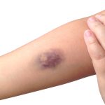 Come coprire un livido col trucco: passaggi utili