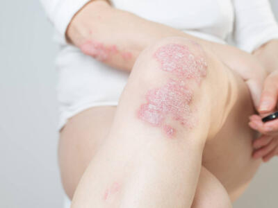 Dermatite atopica: cos’è e quali sono i principali rimedi?