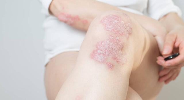 Psoriasi: cosa è, sintomi, cause e come curarla