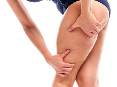 Centella asiatica contro la cellulite: cosa è e benefici