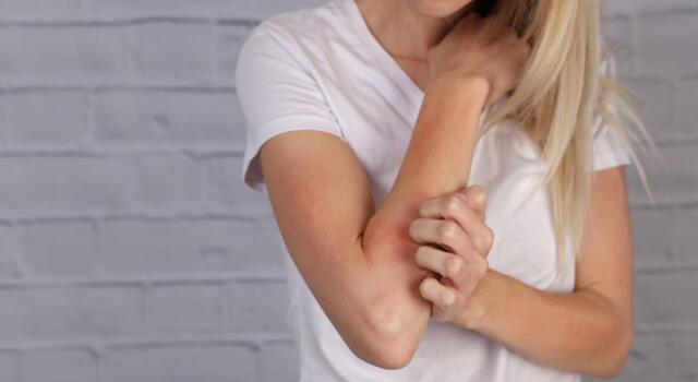 Artrite psoriasica: cosa è, sintomi e come curarla