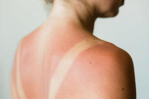 Cos'è l'avvelenamento da sole? Ecco i sintomi e le precauzioni per non correre rischi