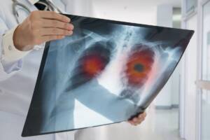Metastasi: cosa sono, come si originano e qual è la migliore prevenzione