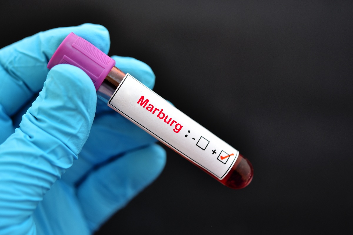 Cos'è il virus Marburg? Sintomi e cura di una patologia altamente letale