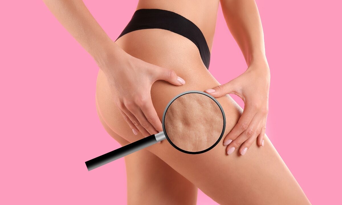 Donna con inestetismi da cellulite