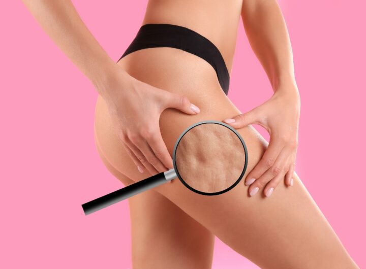 Donna con inestetismi da cellulite