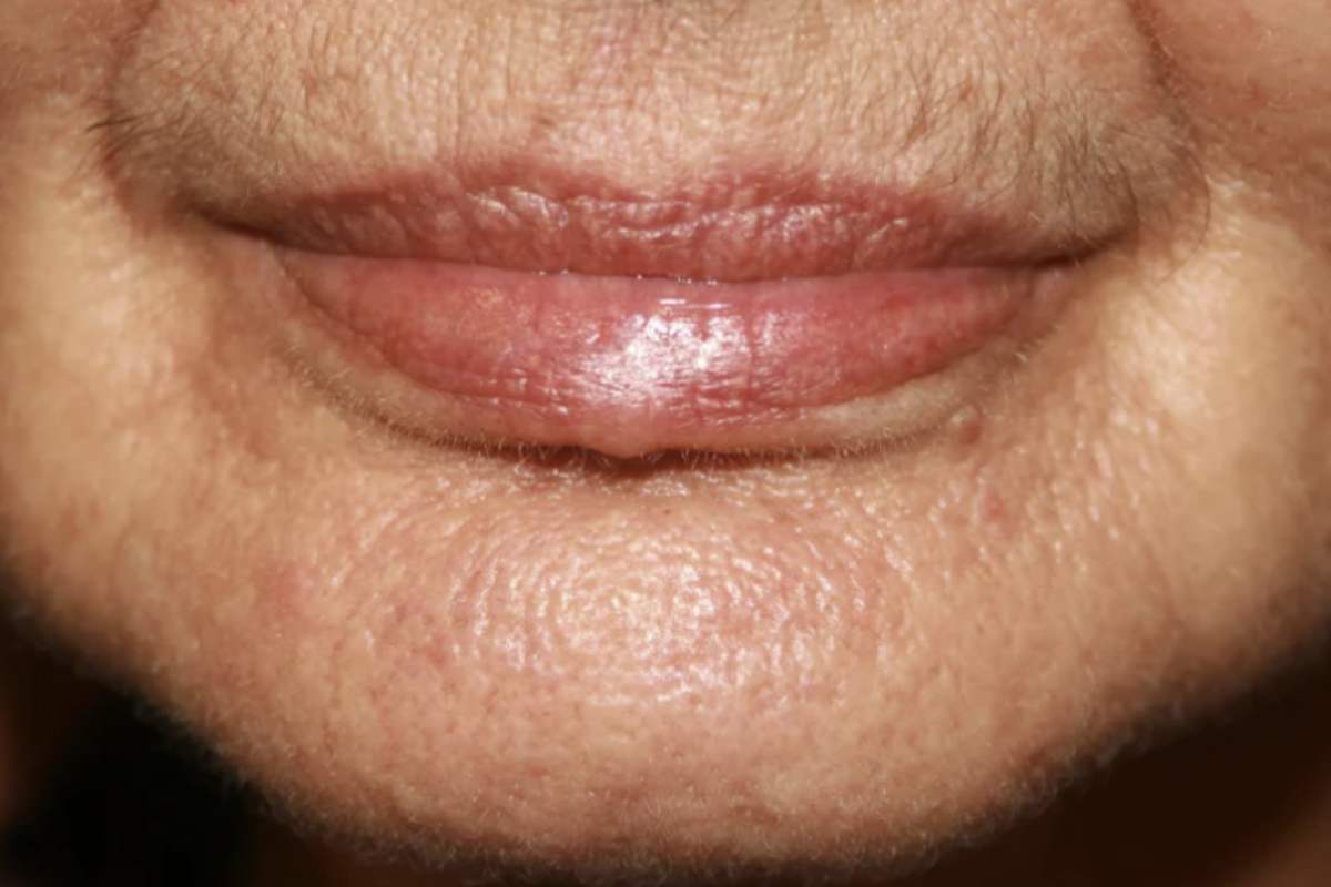 Rughe bocca Oltre agli esercizi di ginnastica facciale, un ruolo centrale nella prevenzione e nel trattamento delle rughe nasolabiali è svolto dai prodotti